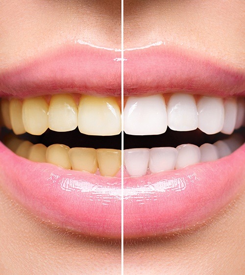 Opalescence Teeth Whitening - Dr. Michael Woolbert