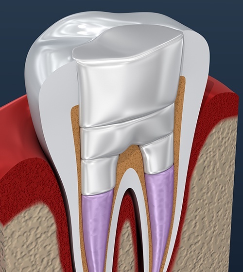What are the different types of root canal treatment?, Dentist in Roswell,  GA, TruCare Dentistry Roswell